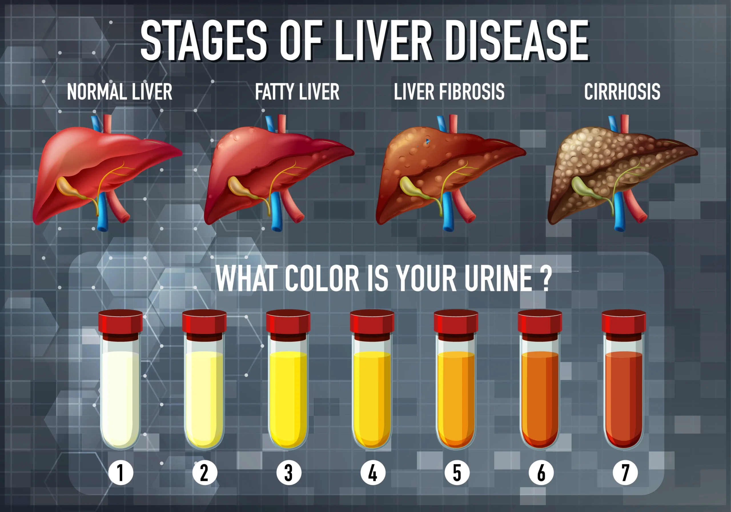 fatty-liver-stages-scaled 21 Day Fatty Liver Diet Plan: Reboot Your Liver in 3 Weeks!